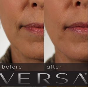 Revanesse Versa derma filler before after photo