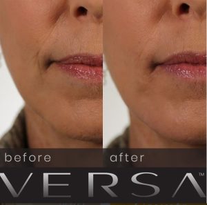 New Revanesse Versa Dermal Filler &#8211; Less Swelling