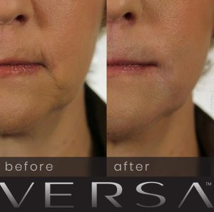 Revanesse Versa derma filler before after photos