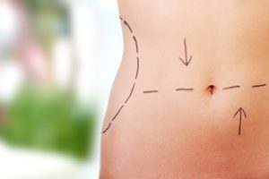 Liposuction Plastic Surgery by Dr. Gary Motykie